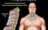 Whiplash Injury