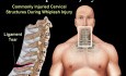 Whiplash Injury