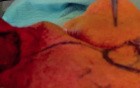 Nasolabial Island Flap - A 89-year-old Male
