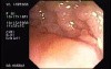 Tubulo - Villous Adenoma - Endoscopy (2 of 28)