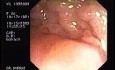 Tubulo - Villous Adenoma - Endoscopy (2 of 28)
