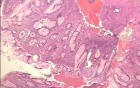 Malign Polyp (6 of 8)