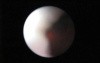Laser Ureteroscopy - Part 2