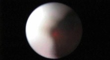 Laser Ureteroscopy - Part 2
