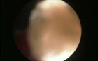 PCNL - Flexible Nephroscope