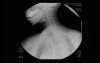 Esophageal Achalasia - Detection of Typical Problems 
