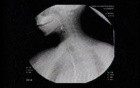 Esophageal Achalasia - Detection of Typical Problems 