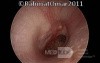 Eardrum Perforation in Inactive Stage