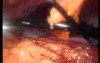 Gastrointestinal Stromal Tumor - GIST (29 of 65)
