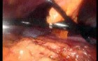Gastrointestinal Stromal Tumor - GIST (29 of 65)