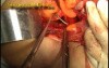 Congenital Prolapse of the Uterus - Sling Procedure, Part 1