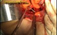 Congenital Prolapse of the Uterus - Sling Procedure, Part 1