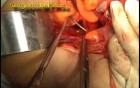 Congenital Prolapse of the Uterus - Sling Procedure, Part 1
