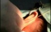 Scarless Auriculoplasty