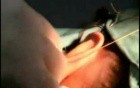 Scarless Auriculoplasty