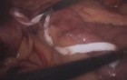 Laparoscopic Gastric Bypass