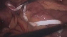Laparoscopic Gastric Bypass