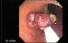 Stalked Polyp - Polypectomy (5 of 6)