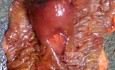 Ascending Colon Intussusception due to a Adenocarcinoma (6 of 6)