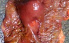 Ascending Colon Intussusception due to a Adenocarcinoma (6 of 6)