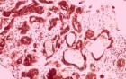 Gallbladder Adenocarcinoma and litiasis (10 of 13)