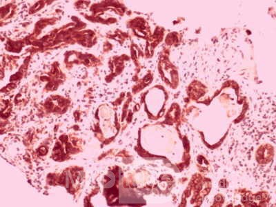 Gallbladder Adenocarcinoma and litiasis (10 of 13)