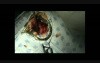 Palatoplasty