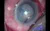 Cataract Surgery - Part 1/2
