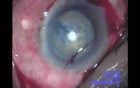Cataract Surgery - Part 1/2