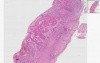 Squamous cell carcinoma