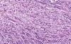 Adenocarcinoma