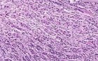 Adenocarcinoma