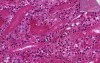 Septic infarct - Histopathology of kidney