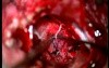 Cerebellopontine Angle Meningioma