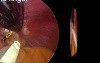 Laparoscopic gastric banding