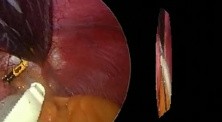 Laparoscopic gastric banding