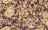 Non-Hodking Lymphoma B Cells. MALT (mucosa associated lymphoid tissue) (5 of 7)
