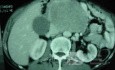 Gastric Ulcer with Gastrocolic fistula due to a Zollinger-
 Ellison Syndrome (26of 33)