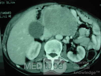 Gastric Ulcer with Gastrocolic fistula due to a Zollinger-
 Ellison Syndrome (26of 33)
