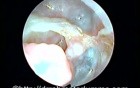 Cavity in the temporal bone after modified radical mastoidectomy