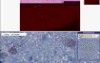 Disseminated intravascular coagulatio - Histopathology of kidney
