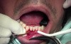 Tunneling Technique - Gingival Grafting #26-25-24