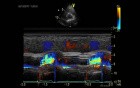 Aortic Paraprosthetic Leak