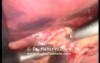 Incarcerated Hiatus Hernia Repair - Laparoscopic Approach