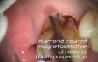 Treatment Of Furcation Caries