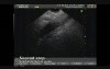 Pancreatic Cancer: EUS-guided Fine Needle Aspiration and Celiac Plexus Neurolysis
