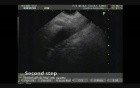 Pancreatic Cancer: EUS-guided Fine Needle Aspiration and Celiac Plexus Neurolysis