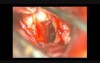 Brain Aneurysm (Anterior Communicating Artery Aneurysm) - Clipping