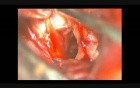 Brain Aneurysm (Anterior Communicating Artery Aneurysm) - Clipping