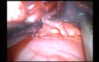 Uniportal VATS Subcarinal Lymph Node Dissection